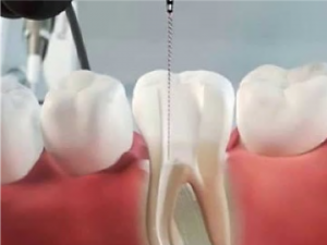 Endodontia automatizada
