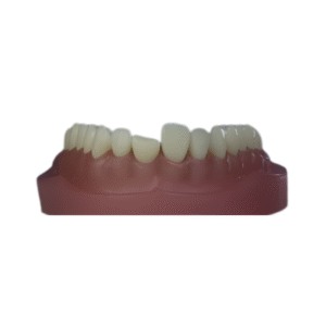 dente-diferenciado-DM-21.6-DENTE-FRATURADO-300×200