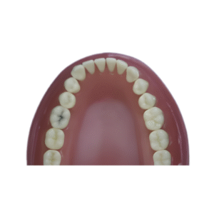 dente-diferenciado-DM-36.3-CARIE-OCULTA-300×200