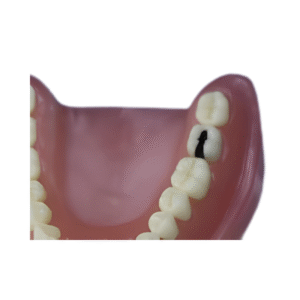 dente-diferenciado-DM-37.7-CLASSE-II-NA-FACE-MO-CARIADO-300×200