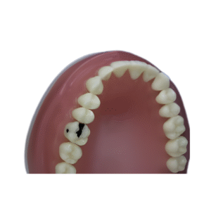 dente-diferenciado-16.2-CLASSE-II-300×200