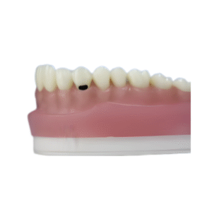 dente-diferenciado-dm-13.5-pronew-300×200